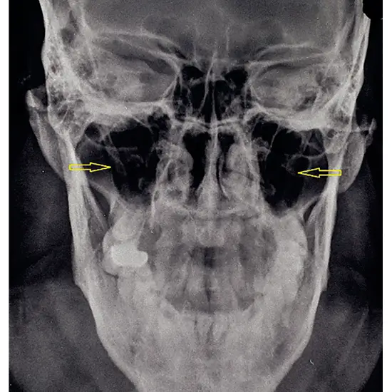 X-ray Skull Townes View